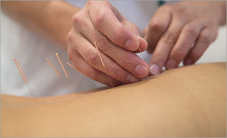 Acupuncture healing by Dr Motz Acupuncture healing by Dr Motz